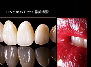 IPS E.Max Press